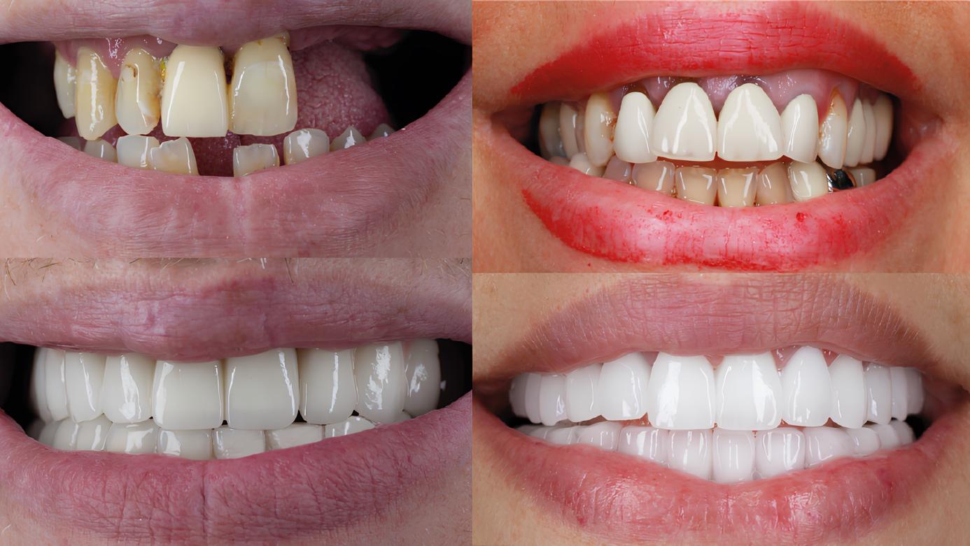 Close-up of a collage of teeth Description automatically generated
